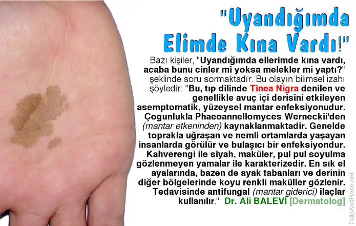 Melanize Mantar Enfeksiyonu (Fayohipomikoz) ve Tinea Nigra: Bazı İnsanların  Elindeki Kahverengi Lekeler, Cinlerin Kına Yakması Nedeniyle mi Oluşuyor?  - Evrim Ağacı