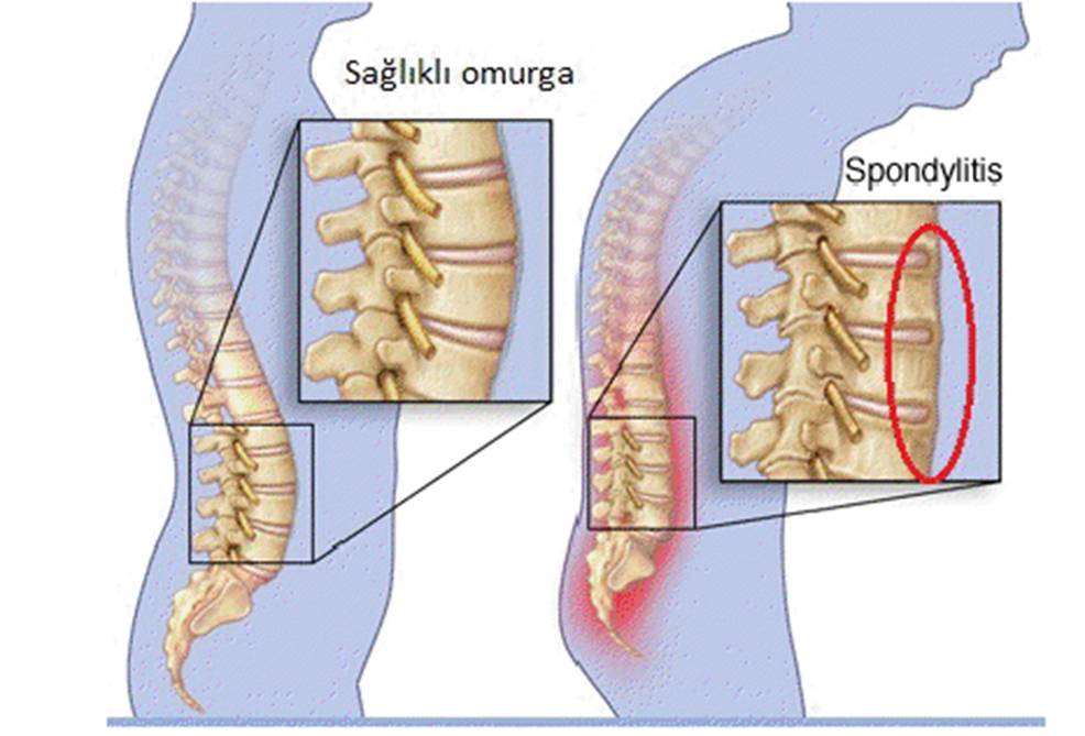 ankilozan spondilit,yaslilik,bel agrilari tedavi dr kamil teker.jpg