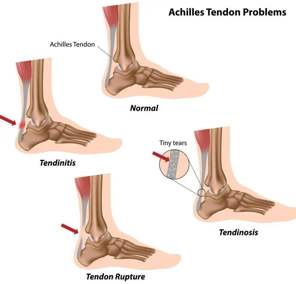 asil-tendonu-kopmasi.webp