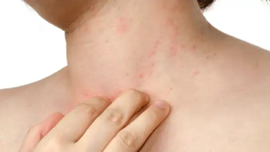 b-vitamini-eksikligi(1).webp