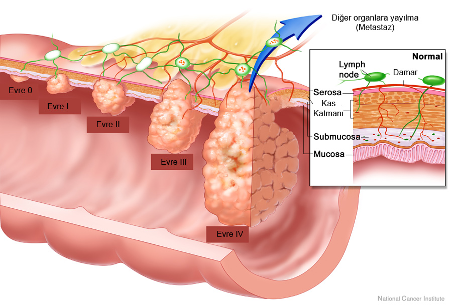 barsak-kanseri-gelisimi.jpg