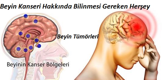 Beyin-Kanseri-Tümörü-Hakkında-Bilinmesi-Gereken-Herşey.jpg