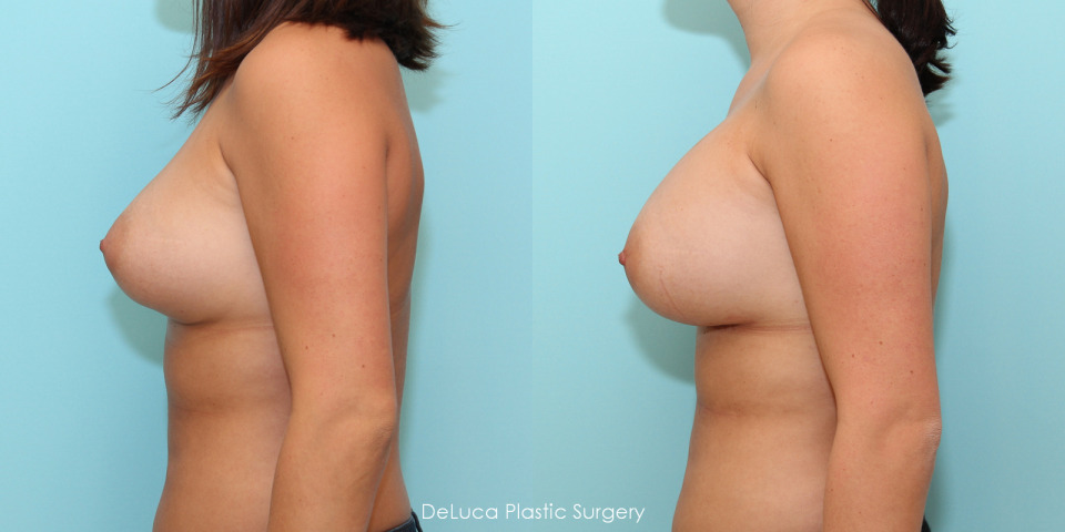 breast-augmentation-before-after-saline-3.jpg