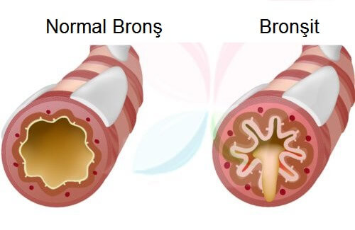 Bronchitis.jpg