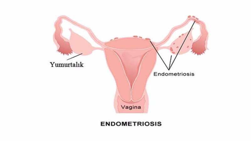 endometriosis1-319x7ak51mnri787naqx34.jpg