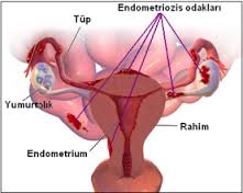 endometriozis.jpg