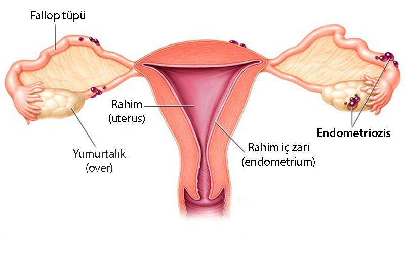 endometriozis-nedir-nasil-olusur-rahim-uterus-yumurtalik-over-fallop-tupu-764498.jpg