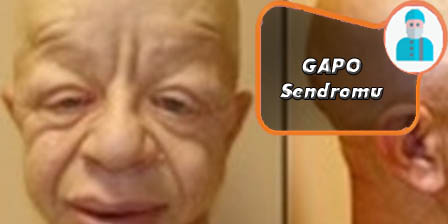 GAPO-Sendromu.jpg