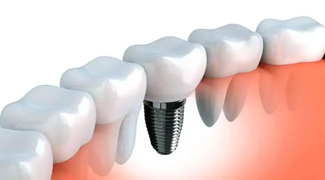 implant-konusunda-bilinmesi-gerekenler-implant-nedir.webp