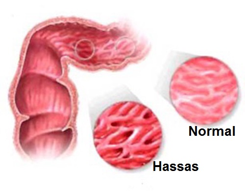 Irritablebowel1.jpg