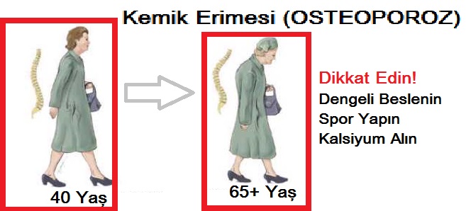 Kemik-Erimesi-OSTEOPOROZ.jpg