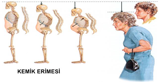 kemik-erimesi-osteoporoz-vucutcu-fazlic.jpg