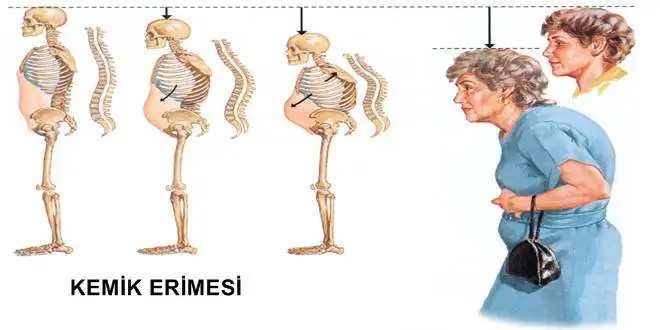 kemik-erimesi-osteoporoz-vucutcu-fazlic.webp