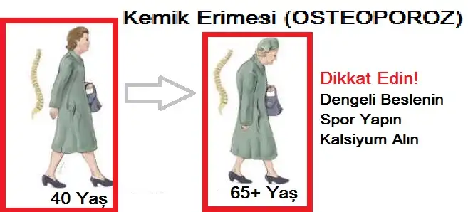 Kemik-Erimesi-OSTEOPOROZ.webp