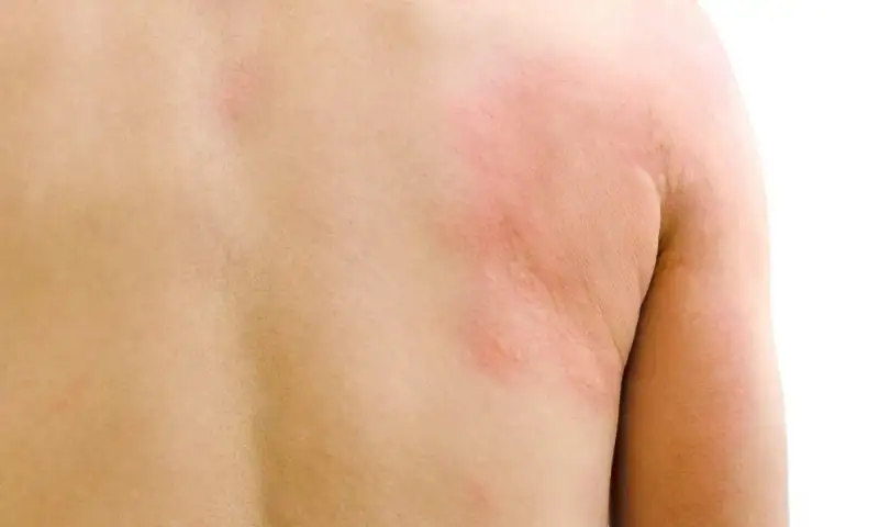 Non-Itchy-Hives-–-Do-they-Really-Occur.webp