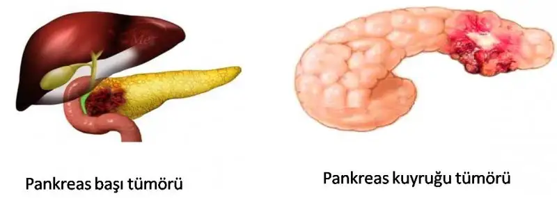 pankreas2.webp