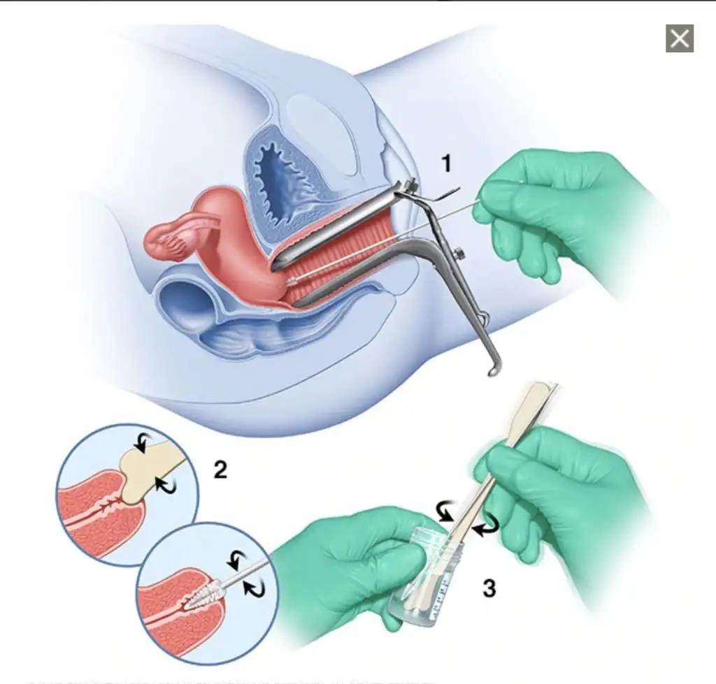 pap_smear_testi_nasil_yapilir_sonucu.jpg