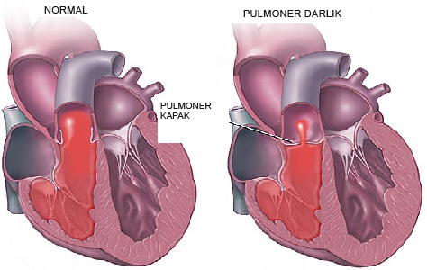 pulmoner-darlik.jpg