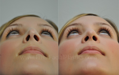 Revision nose job houston.jpg