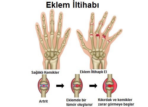 romatoid-artrit-21.jpg