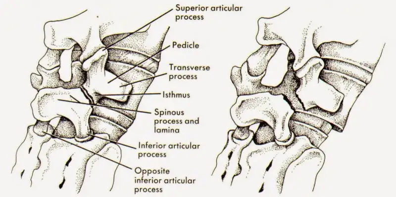 scotty-dog-spondylolisthesis.webp