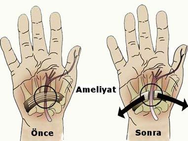 Sinir-sıkışması.jpg