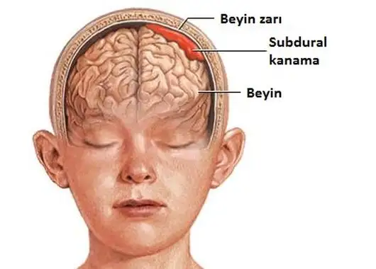 subdural-hematom.webp