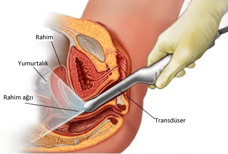 Transvajinal ultrason sırasında doktor veya tıp teknisyeni asa benzeri bir transduser cihazı, siz sırt üstü yatarken vajinanızdan sokar. Bu cihaz pelvik organlarınızın görüntülerini yaratan ses dalgaları yayar. 