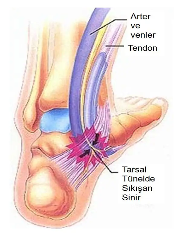 tarsal2.jpg