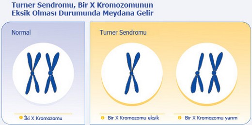 turner-sendromu-nedir.jpg