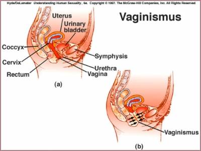 vaginismus-nedir-1.jpg