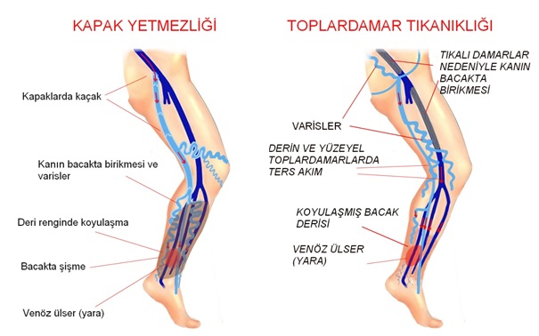 venoz-toplardamar-yetmezlik.jpg