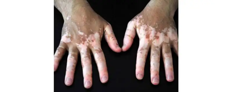 vitiligo-antalya.webp