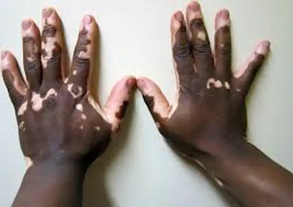 vitiligo.webp