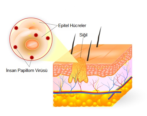 wart-21.jpg