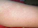 keratosis_pilaris_1_0303241.jpg