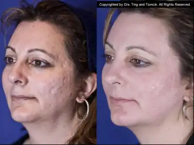 $fractional_co2_laser_resurfacing_acne_scar_white_female_hn5e[1].webp