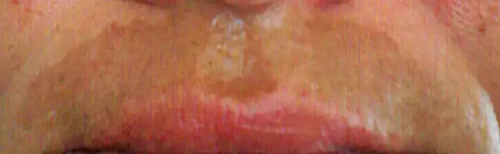 Bıyık lekesi12.webp