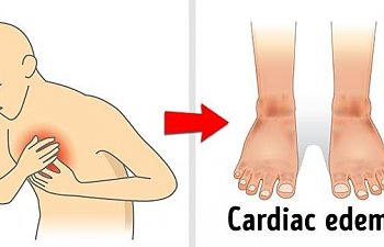 Bu hastalıkların en önemli belirtisi ödem!