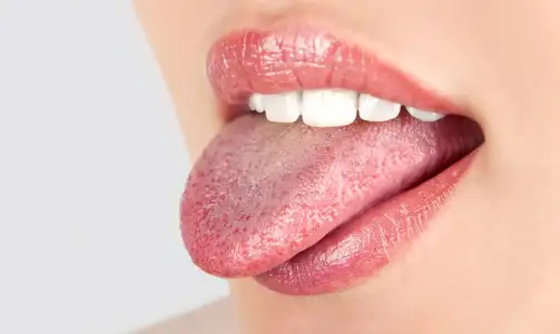 Kıllı Dil Hastalığı Nedir? Nasıl Tedavi Edilir?