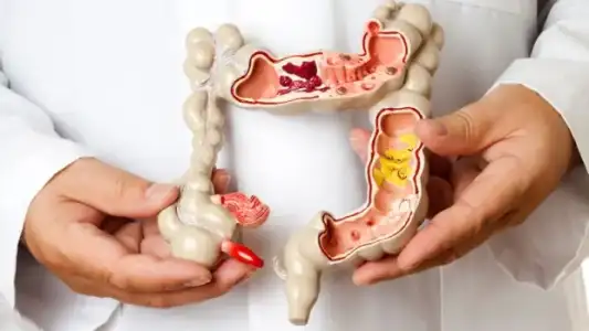 Crohn Hastalığı Nasıl Tedavi Edilir? Kansere Neden Olur?