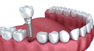 Disimplanti-implant-fiyatlari-nafiyeesraorman.jpg