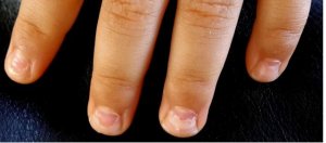 Peeling-Nails-Nails-Falling-Off-shedding-nails-Onychomadesis-hand-foot-and-mouth.jpg