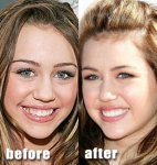 $miley-cyrus-before-after-teeth.jpg