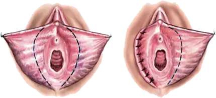 labioplasti.webp