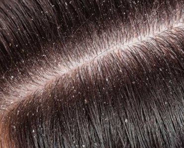 Saç Dökülmesini, Kepeği Önlemek ve Saç Uzaması İçin Karabiber Yağı