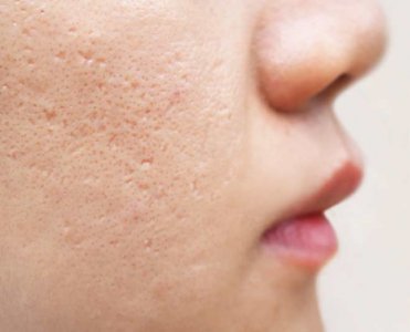 Tavuk Derisi (Keratosis Pilaris) Hastalığı Nedir? Tedavisi