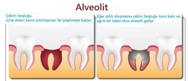 20_yas_dis_cekimi_sonrasi_alveolit_dis_iltihabi.jpg