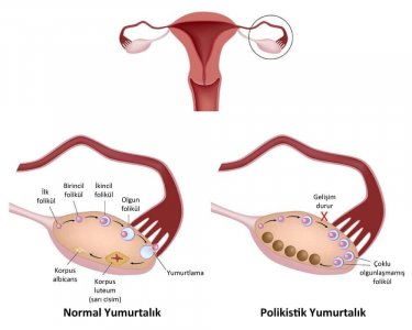 Polikistik Over Nedir.jpg