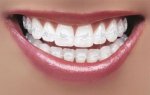 $ceramic-braces.jpg